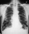 CHondrosarcoma tibia pulmonary mets 70M