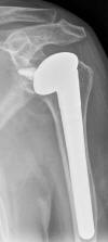 TSA Zimmer BiglianiFlatow offset modular humeral head 75F
