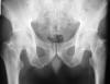 70F fibrous dysplasia of femoral neck