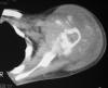 Osteosarcoma humerus path fx 18M
