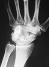 Coalition avulsion bossu