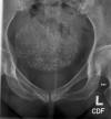 Huge uterine fibroid 65F