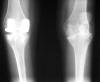 Hemophilia knees 38M