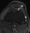 Bipartite patella