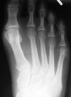 Reiter's syndrome 34M