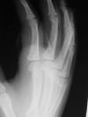 CRF resorption 15F