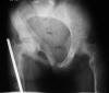 McCune Albright syndrome 9F