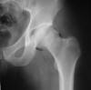 IA body hip arthro 29M