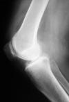 Parsons knob 61M Posterior osteophyte