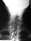 Fluoride Rx of osteoporosis