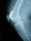 Patellofemoral prosthesis