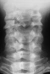 C4-5 bifacet subluxation 33F