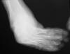 Equinus foot ankle 35F
