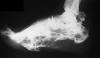 Osteochondroma foot 30F