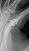 Arthroplasty-MCP fx