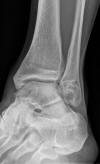 Chrisman Snook versus Evans lateral ankle reconstruction