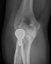 Proximal radial hemiarthroplasty