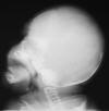 Aperts syndrome Craniosynostosis Syndactyly 0M