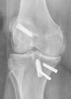 ACL MCL 73F