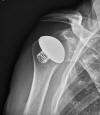 Arthrex Eclipse total shoulder arthroplasty system with an Affinit glenoid