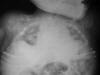 Osteogenesis imperfecta congenita 0M