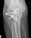 Skeletal Dynamic internal joint stabilizer