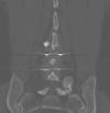 Radiolucent interspinous spacers 55F
