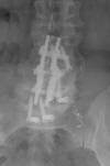 Spinous process clamps