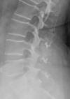 DIAM inter spinous process spacers