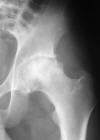 Femoral head graft for AVN 28M