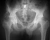 30M paraplegic, soft tissue calcification