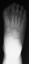Myositis Ossificans Progressiva 3M