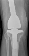 Fully constrained hinged TKA