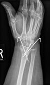 Kapandji pinning distal radius