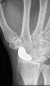Scaphoid arthroplasty