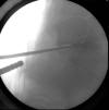 L5 S1 disc arthroplasty