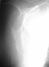 Disarticulation, mastectomy