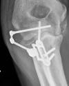 Skeletal Dynamic internal joint stabilizer