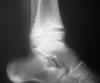 CRF resorption 17M