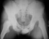 Posterior hip dislocation 20M