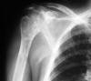 Radiation necrosis shoulder 69F