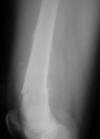 OSA femur 11F