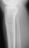 Enchondroma prox tibia 65F