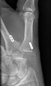 Interposition arthroplasty of left thumb carpometacarpal Arthrex tightrope