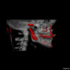TMJ replacement 3D