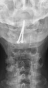 Odontoid fracture screw fixation