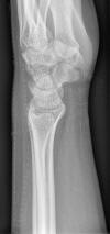 Skin splint wrist