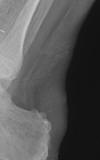 Achilles repair suture
