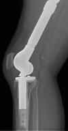 Fully constrained hinged TKA