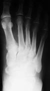 Thyroid acropachy 61M